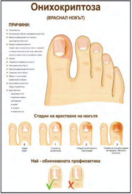 Снимка на Плакат „Онихокриптоза“