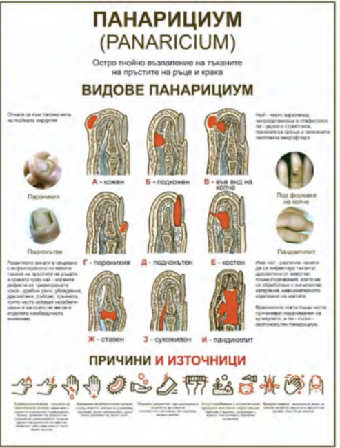 Снимка на Плакат „Панарициум“